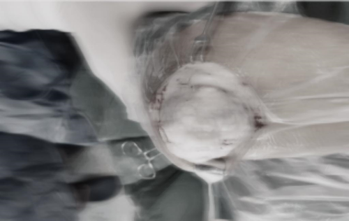 痛风石_副本.png