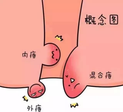 内痔_副本.png