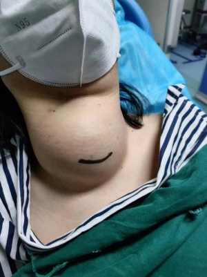 甲状腺肿物_副本.png
