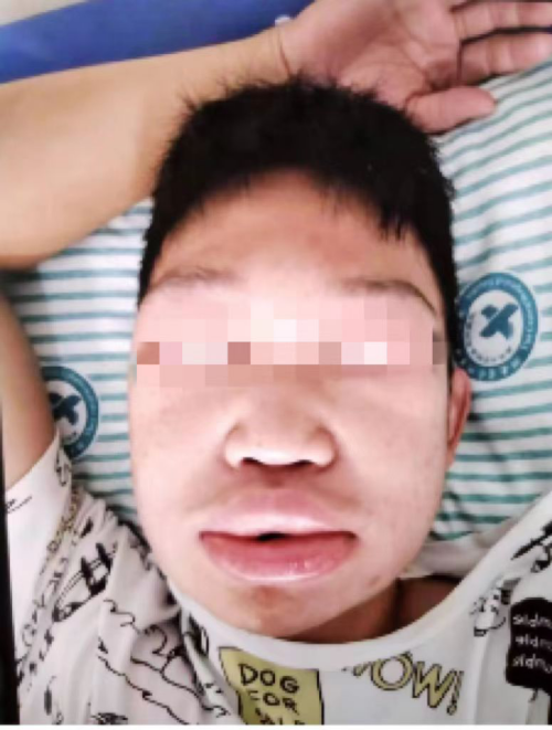 陈威面部水肿发作时照片_副本.png